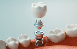 Digital image of a dental implant post, abutment, and crown