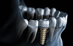 a graphic illustration depicting a dental implant